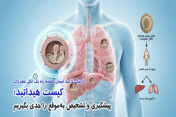 کیست هیداتید را با پیشگیری و تشخیص به‌موقع جدی بگیریم