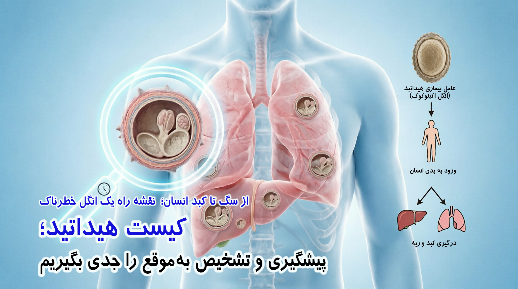 کیست هیداتید؛ از پیشگیری تا درمان 